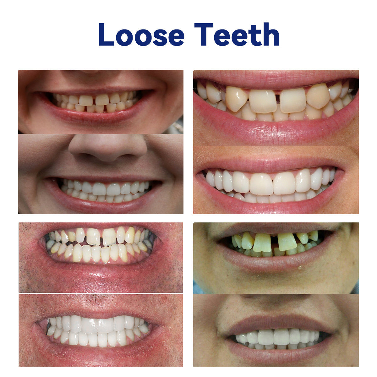 𝐵𝑖𝑘𝑒𝑛𝑑𝑎™ 𝑆𝑖𝑙𝑖𝑐𝑜𝑛𝑒 𝐷𝑒𝑛𝑡𝑢𝑟𝑒 𝑅𝑢𝑙𝑒𝑟 𝑆𝑒𝑡 (👩‍🔬👩‍🔬BDA 𝐶𝑜𝑚𝑝𝑙𝑖𝑎𝑛𝑡 𝐴𝑝𝑝𝑟𝑜𝑣𝑒𝑑 𝐵𝑦 𝑃𝑟𝑜𝑓𝑒𝑠𝑠𝑖𝑜𝑛𝑎𝑙 𝐷𝑒𝑛𝑡𝑖𝑠𝑡𝑠）🔥🔥